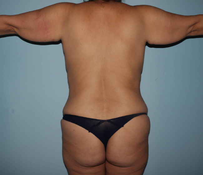 Before Arm lift Before and After Photo Back View Case 6564