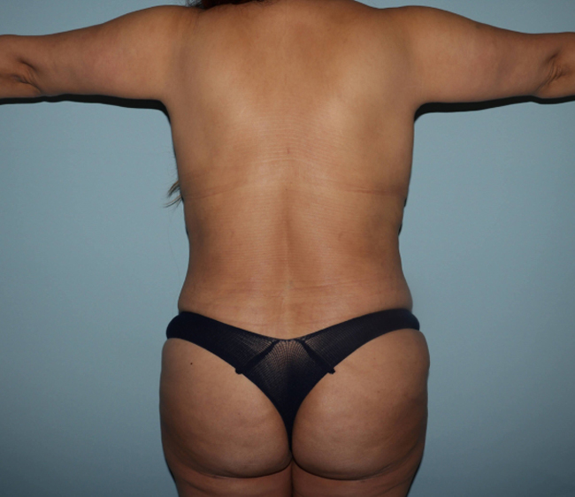 After Arm lift Before and After Photo Back Side View Case 6564