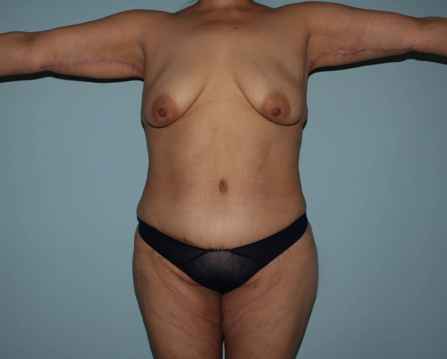 After Arm lift Before and After Photo Front Side View Case 6564