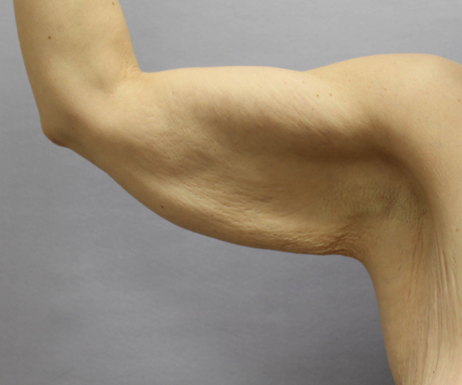 image before arm lift after weight loss - front view case 6559