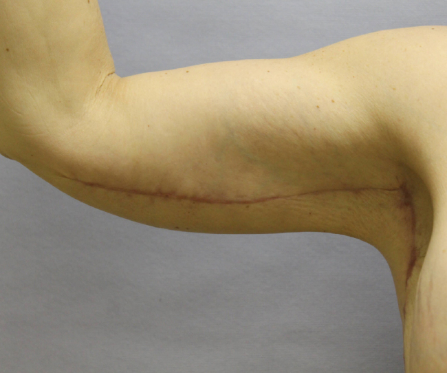 image after arm lift after weight loss - front view case 6559