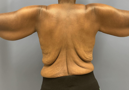 image before arm lift - bra line back lift back view case 6675