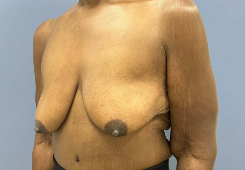 image before arm lift - bra line back lift left case 6675