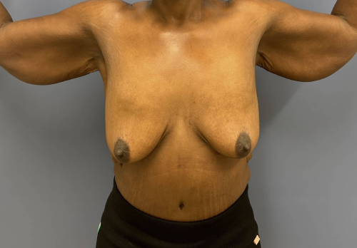 image before arm lift - bra line back lift front view case 6675