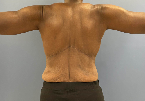 image after arm lift - bra line back lift back view case 6675