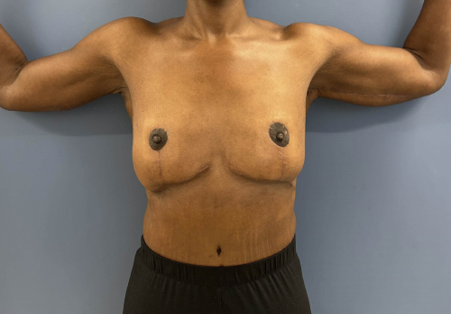 image after arm lift - bra line back lift front view case 6675