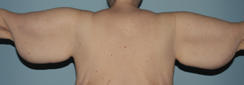 image before arm lift after massive weight loss - back view case 6669