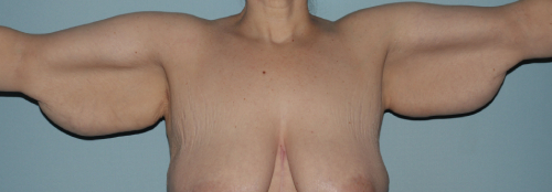 image before arm lift after massive weight loss - front view case 6669