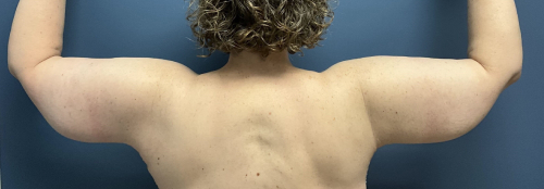image after arm lift after massive weight loss - back view case 6669