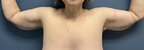 image after arm lift after massive weight loss - front view case 6669