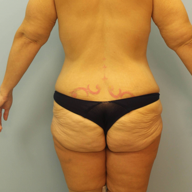 image before body lift after arm lift - back view buttocks area case 6599