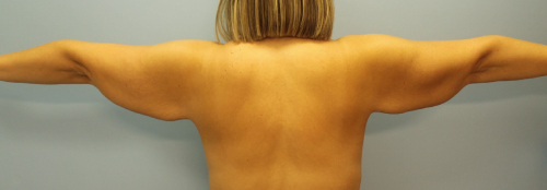 image before body lift after arm lift - back view case 6599