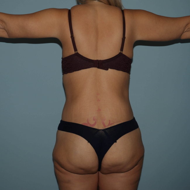 image after body lift after arm lift - back view arms sideward case 6599