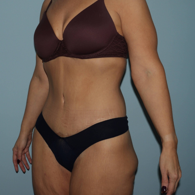 image after body lift after arm lift - 45 degrees left angle case 6599