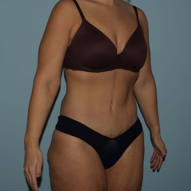 image after body lift after arm lift - 45 degrees right angle case 6599