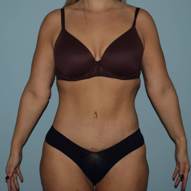 image after body lift after arm lift - front view arms on side case 6599