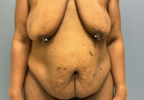 image before arm lift, abdominoplasty and mastopexy - front view arms on side case 6598