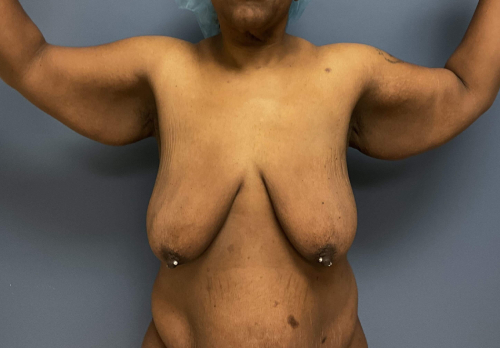 image before arm lift, abdominoplasty and mastopexy - front view arms sideward case 6598