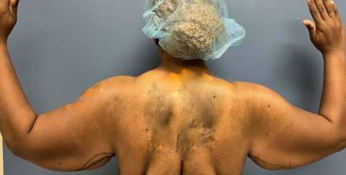 image before arm lift, abdominoplasty and mastopexy - back view case 6598
