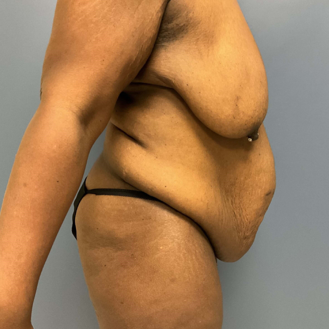 image before arm lift, abdominoplasty and mastopexy - right angle case 6598
