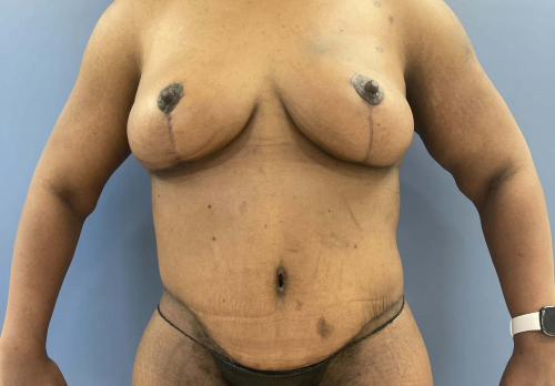 image after arm lift, abdominoplasty and mastopexy - front view arms on side case 6598