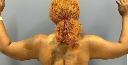 image after arm lift, abdominoplasty and mastopexy - back view case 6598