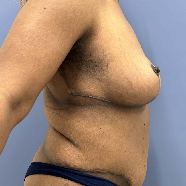 image after arm lift, abdominoplasty and mastopexy - right angle case 6598