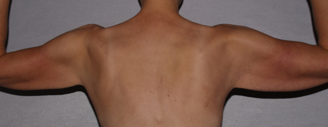 before brachioplasty and breast augmentation back view case 6551