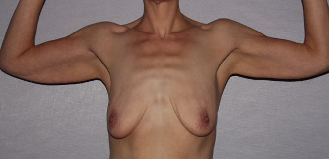 before brachioplasty and breast augmentation front view case 6551