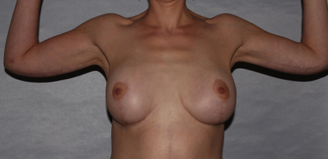 after brachioplasty and breast augmentation front view case 6551