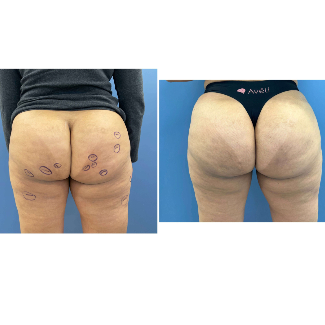 Before and After Image of Aveli for Buttock Dimpling With BBL Back Side View Case 6989