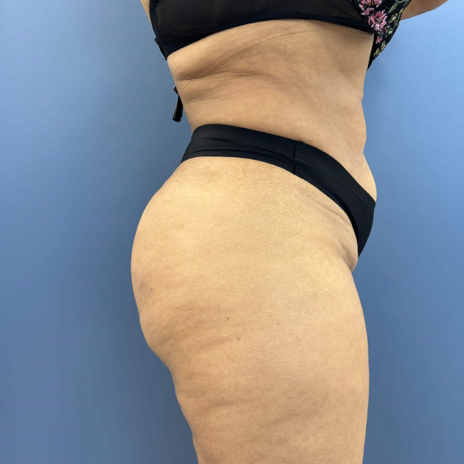 After Image of Aveli for Buttock Dimpling With BBL Right Side View Case 6989