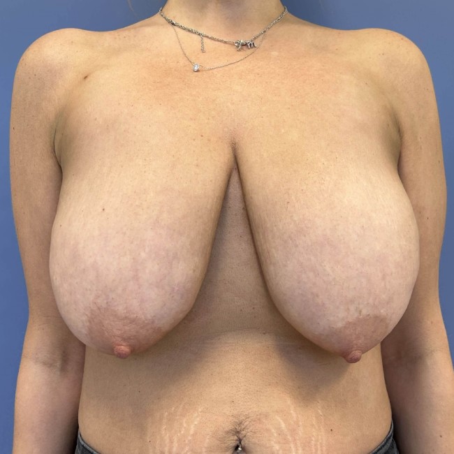 before Breast lift with Implants female patient front view case 7816