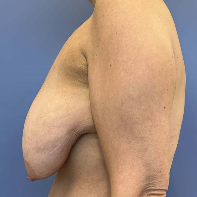 before Breast lift with Implants female patient left side case 7816