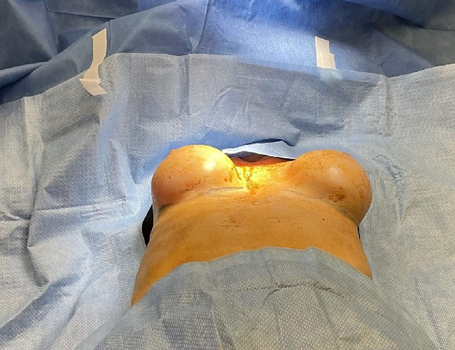 image before removing breast implant case 5533