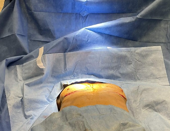 image after breast implant being removed case 5533