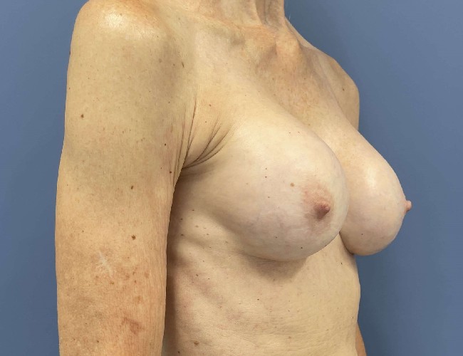 image before breast implant removal - fat transfer 45 degrees right angle case 5533