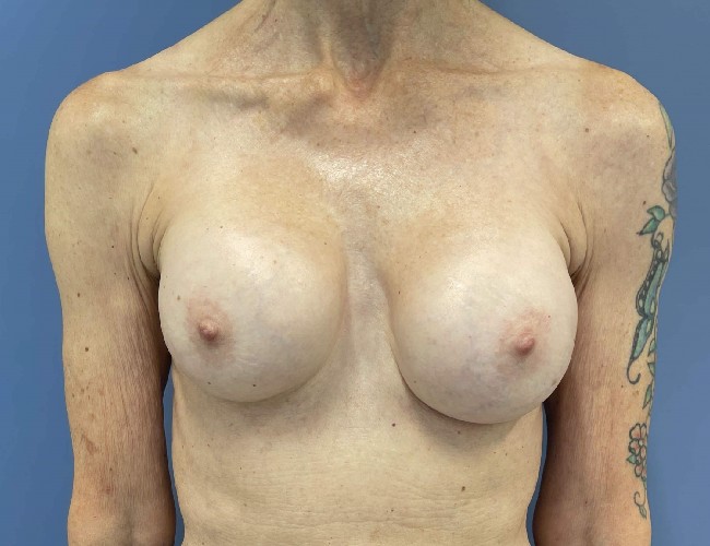 image before breast implant removal - fat transfer front view case 5533