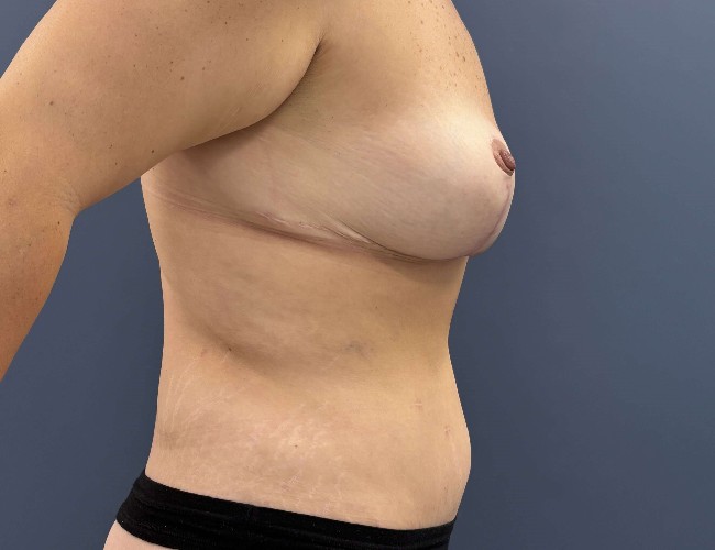 image after breast implant removal view - right angle case 6434