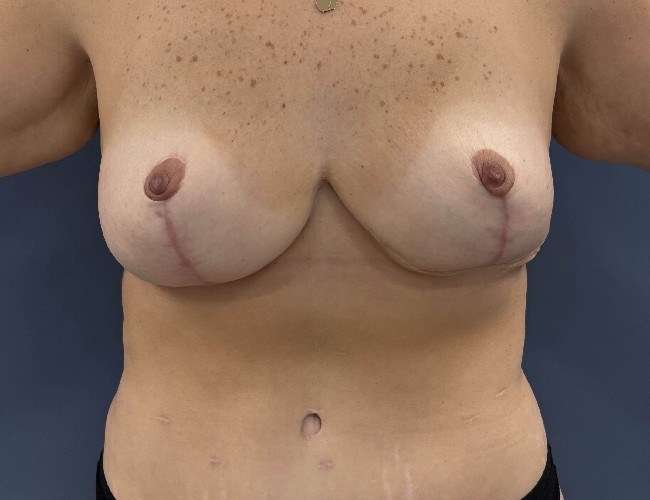 image after breast implant removal - front view case 6434