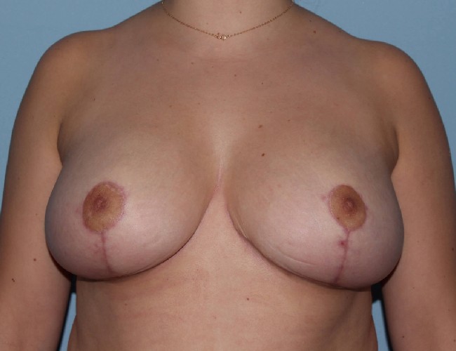 after breast reduction - reduction mammaplasty front view case 4943