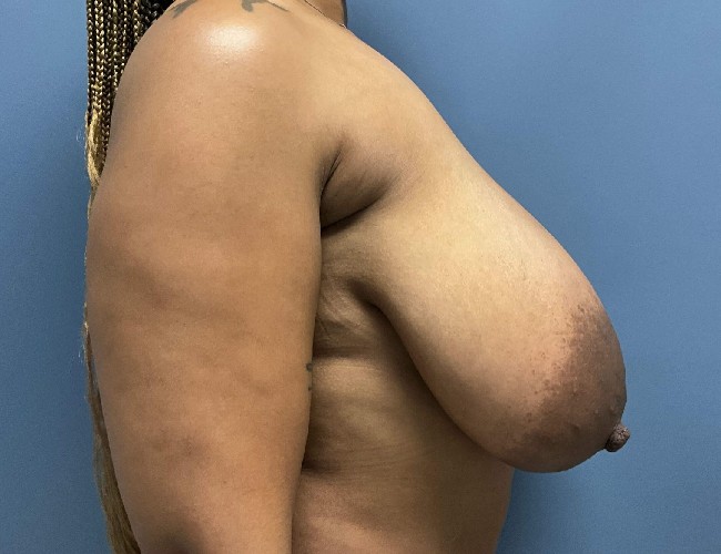Before Image of Breast Reduction macromastia Dr Lyle Raleigh NC right side view case 4963