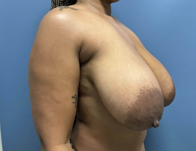 Before Image of Breast Reduction macromastia Right 45 degrees right angle case 4963