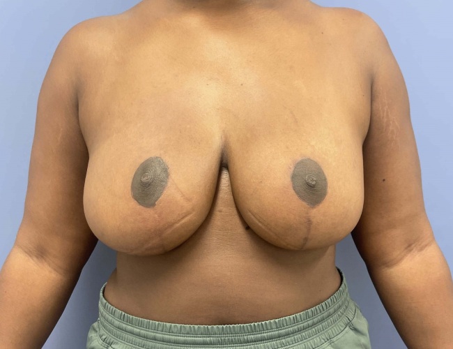 image after breast reduction - G cup breast front view case 7534