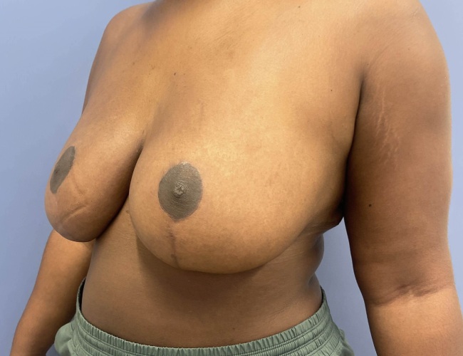 image after breast reduction - G cup breast 45 degrees left angle case 7534