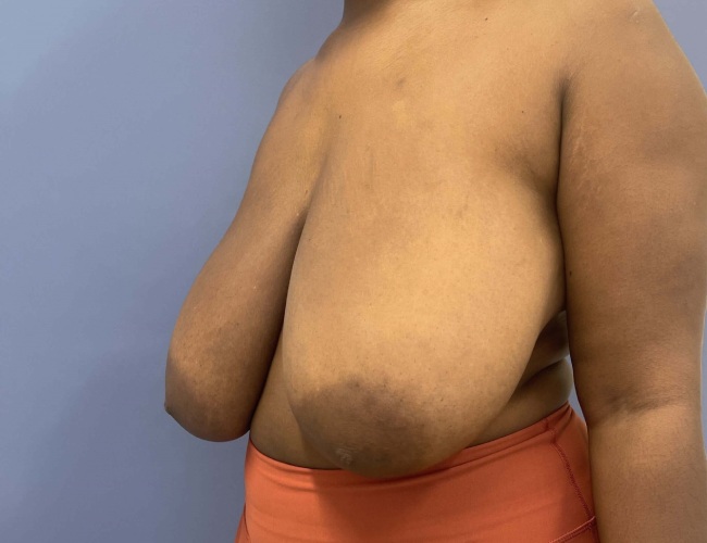 image before breast reduction - G cup breast 45 degrees left angle case 7534