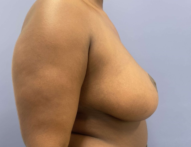image after breast reduction - G cup breast right angle case 7534