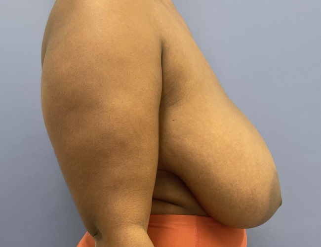 image before breast reduction - G cup breast right angle case 7534