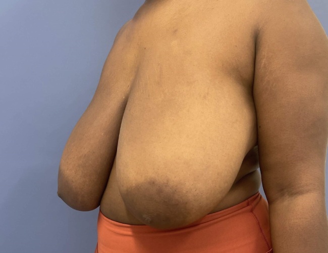 image before breast reduction - G cup breast left angle case 7534