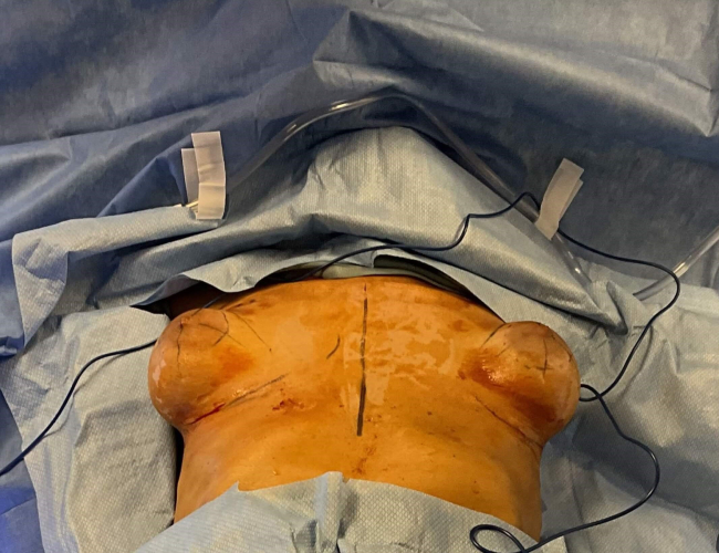 Operation Image of Breast Revision with Capsulectomy Case 4910